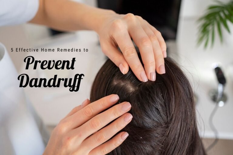 5 Effective Home Remedies to Prevent Dandruff