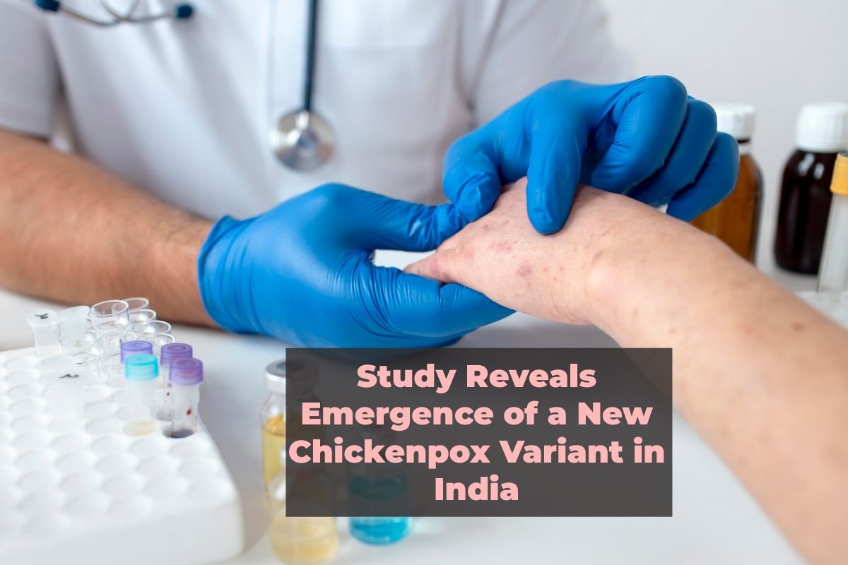 Study Reveals Emergence of a New Chickenpox Variant in India