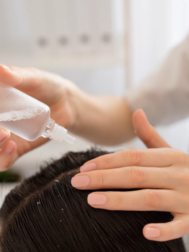 5 Effective Home Remedies to Prevent Dandruff